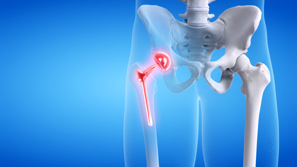 Total hip replacement in Palos Hills, IL
