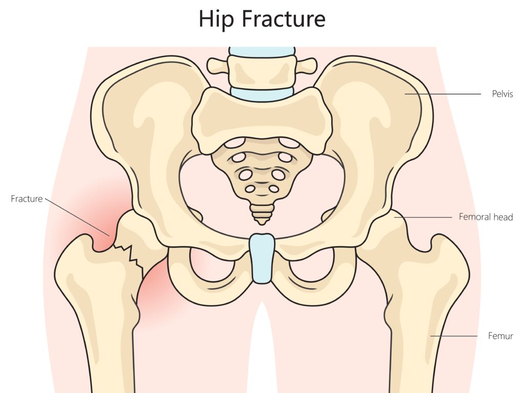 Hip fracture treatment in Palos Hills