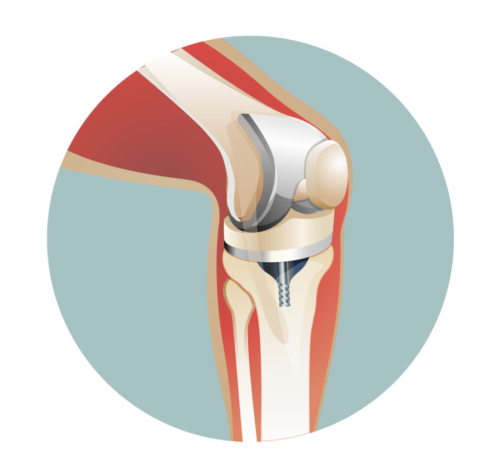 Physical therapy after joint replacement in Palos Hills and Mokena, IL
